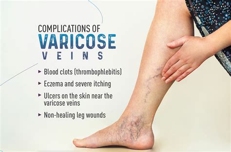 Complications of varicose veins