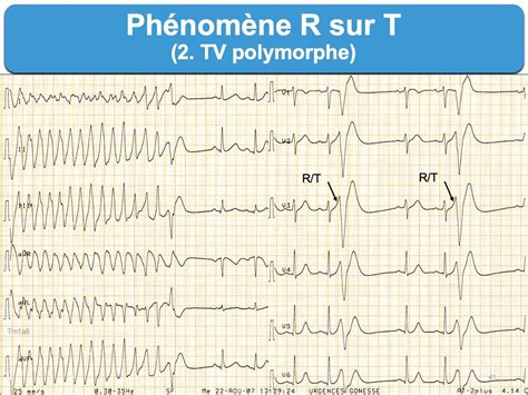 Phénomène R sur T : e-cardiogram