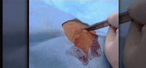 How to Remove a mole using punch biopsy « Medical Diagnosis & Procedures :: WonderHowTo