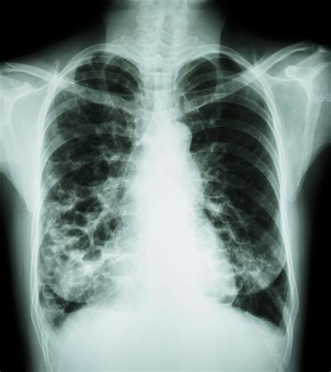 Chest X-Ray for Sarcoidosis Screening in Uveitis Patients Needs More Study