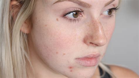 Top 10 Fastest Acne Treatment Ways for Teens