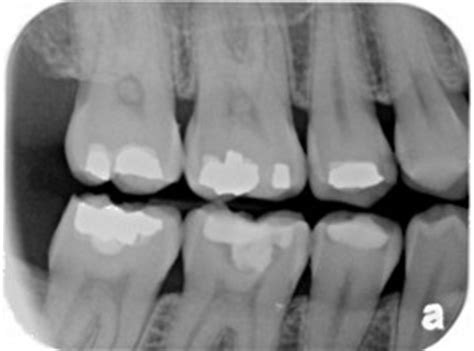 Dental radiography or dental X-ray