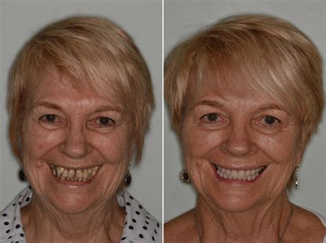 All-on-4 ® Dental Implants Photos | Miami | Patient 8598