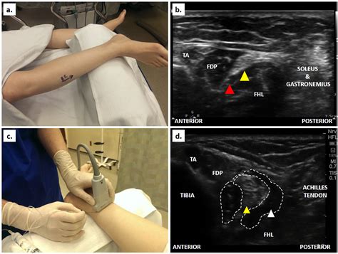 How I Do It: Ultrasound-Guided Ankle Block