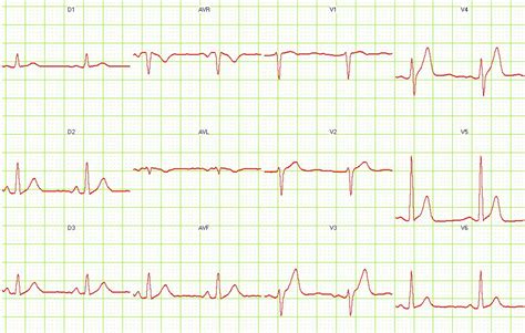 Hypocalcemia Ekg