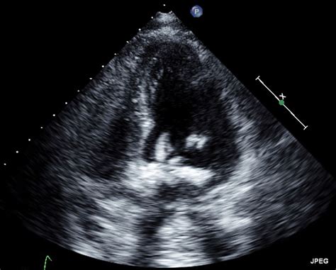 Incidental cardiac papillary fibroelastoma: a management dilemma | BMJ Case Reports