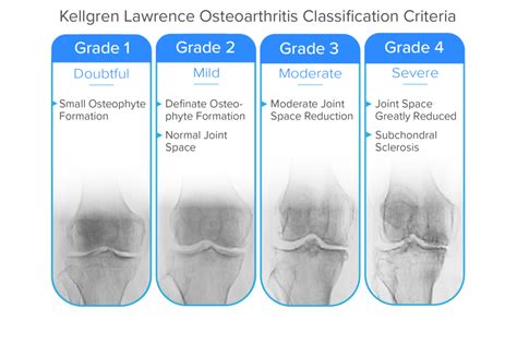 Guide to Severe Knee Arthritis (Osteoarthritis) - Spring Loaded Technology