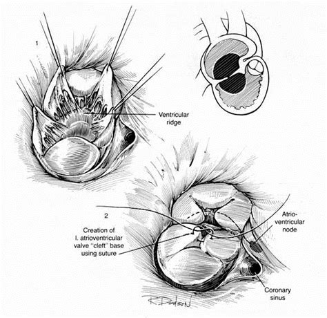 Atrioventricular septal defect surgery - wikidoc