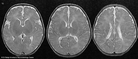 Dr Balaji Anvekar FRCR: Germinal matrix hemorrhage MRI Brain