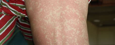 Maculopapular Rash: Causes, Appearance, and Treatment