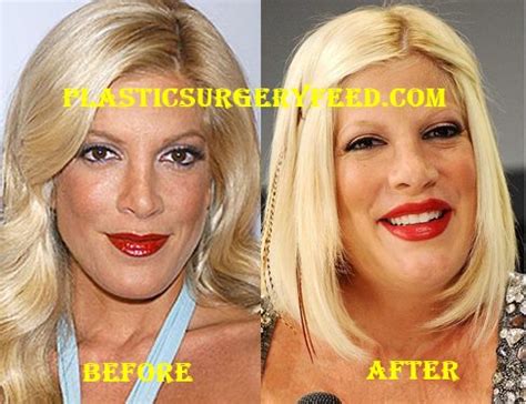 Tori Spelling Before and After Plastic Surgery - Plastic Surgery Feed