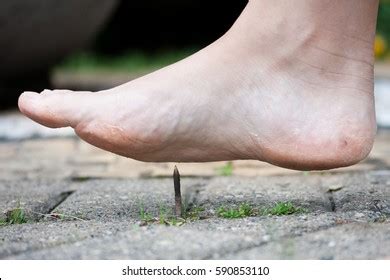 Puncture Wound Photos, Images & Pictures | Shutterstock