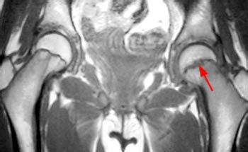 Slipped Capital Femoral Epiphysis | Radsource