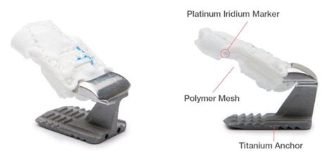 Barricaid Prosthesis Study Enrolls 300th Patient | Orthopedics This Week