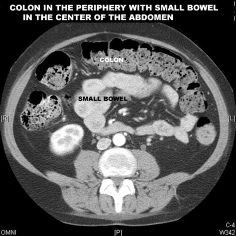 Bowel obstruction / Ileus