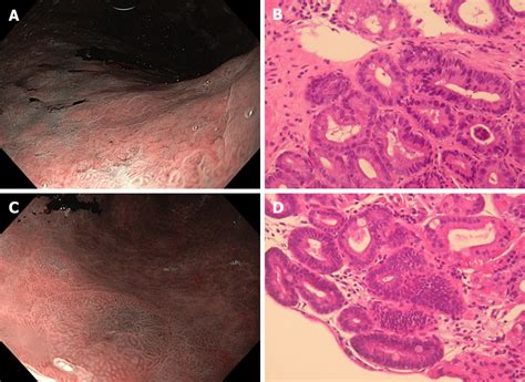 Helicobacter pylori-induced inflammation masks the underlying presence of low-grade dysplasia on ...