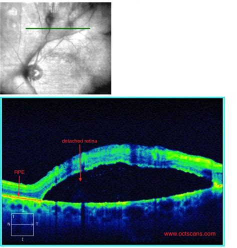 Diabetic Retinopathy - Optical Coherence Tomography Scans