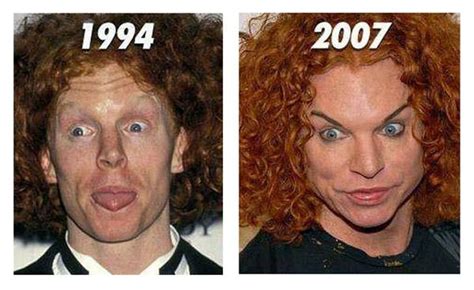 Carrot Top Plastic Surgery Before and After - Star Plastic Surgery Before and After