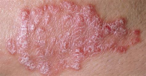 Psoriasis vs. lupus: Similarities and differences