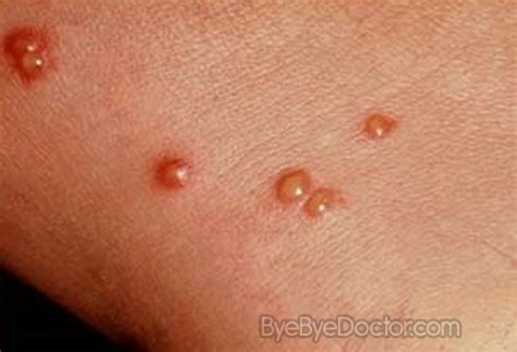 Chigger Bite – Pictures, Symptoms and Treatment