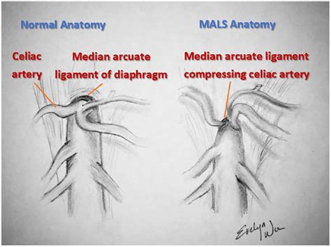 Median Arcuate Ligament Syndrome - Evelyn Wu, 2019