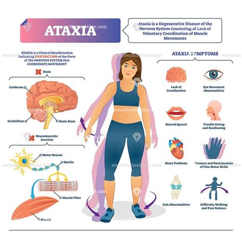 Ataxia disease medical vector illustration infographic | Farmacologia enfermeria, Ejercicio ...