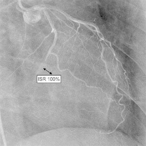 Stent in left circumflex coronary artery showing 100% in‑stent restenosis | Download Scientific ...