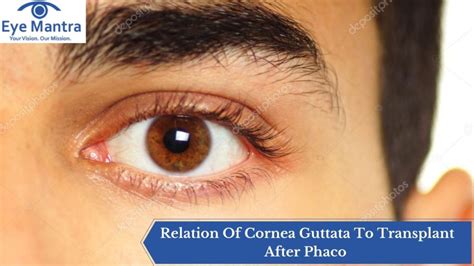 Relation Of Cornea Guttata To Transplant After Phaco