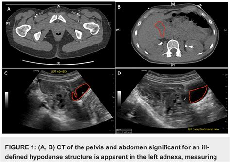 Figure 1 from A Case of Hemorrhagic Ovarian Cyst Rupture Necessitating Surgical Intervention ...