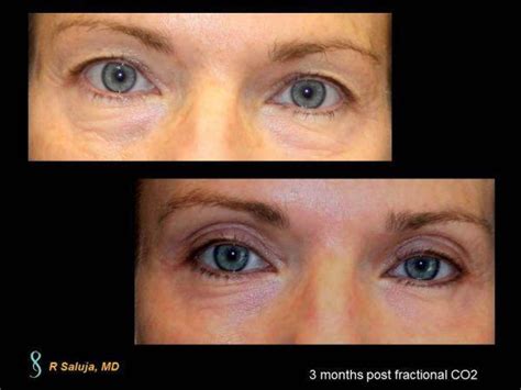 Fractional CO2 Laser Before & After - Charlotte Huntersville, NC ...