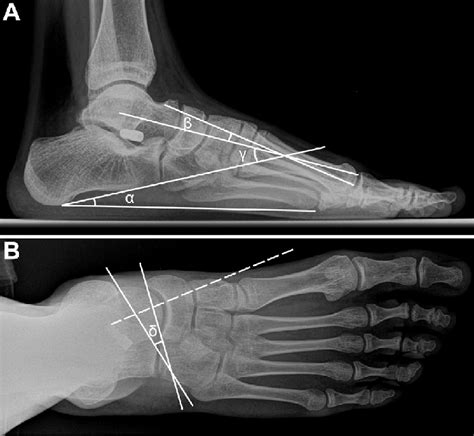 e Case 1. Lateral (A) and anteroposterior (B) weightbearing radiographs... | Download Scientific ...