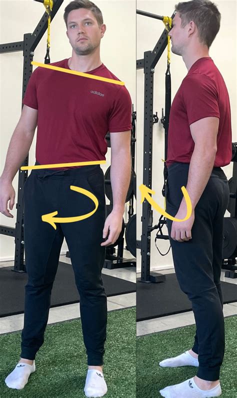 A Comprehensive Guide To Fixing Lateral Pelvic Tilt (2022)