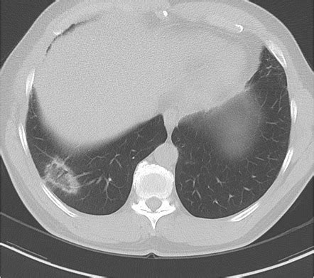 Atoll sign (lungs) | Radiology Reference Article | Radiopaedia.org