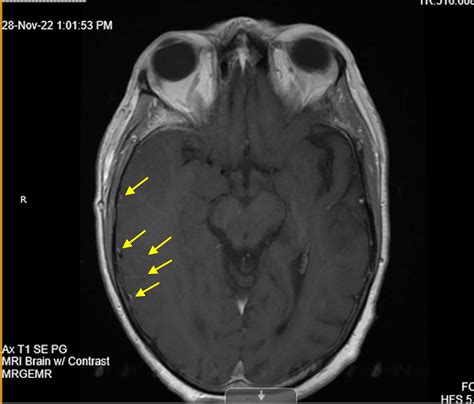 Encephalitis Mri