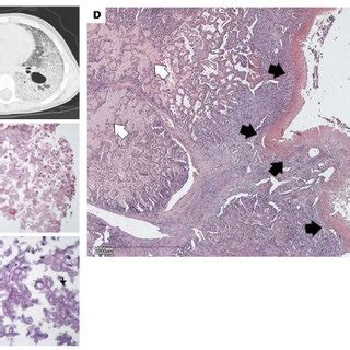 Diagnosis of alveolar proteinosis was suspected based on typical ...