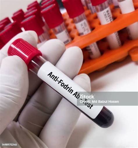 Blood Sample For Sjogrens Antibody Panel Test Sjogren Ssa Ssb Antiro And Antila Test Stock Photo ...