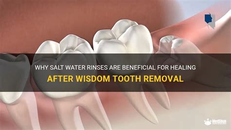 Why Salt Water Rinses Are Beneficial For Healing After Wisdom Tooth ...