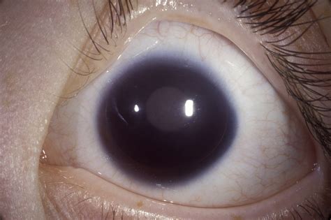 Study: Iris Implant Safe, Effective Aniridia Treatment - Ophthalmology Advisor