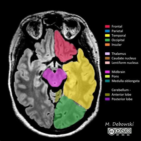 Cerebral hemisphere | Radiology Reference Article | Radiopaedia.org | Radiology, Mri, Brain lobes