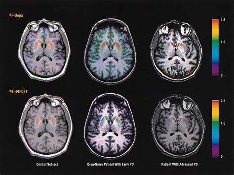 Dopaminergic Function and Dopamine Transporter Binding Assessed With Positron Emission ...