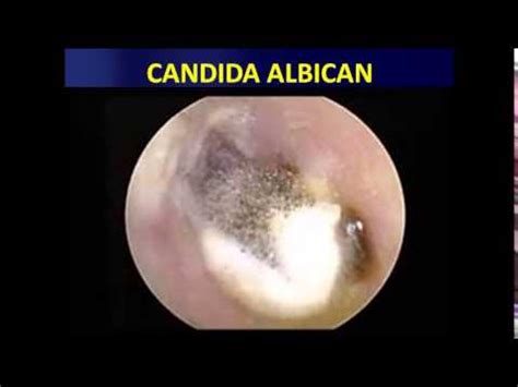 EAR FUNGAL INFECTION DR FOHEID ALSOBEI - YouTube