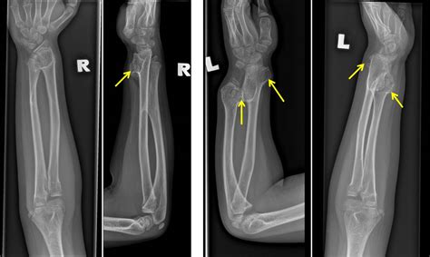 Hereditary multiple exostosis – Radiology Cases