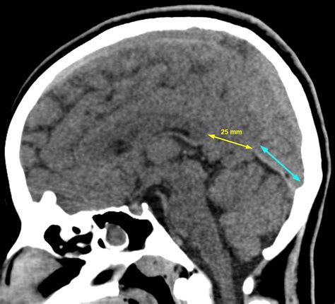 Bilateral Occipital Lobe Herniations Due to Asymmetric Tentorial Defects: Incidental Computed ...