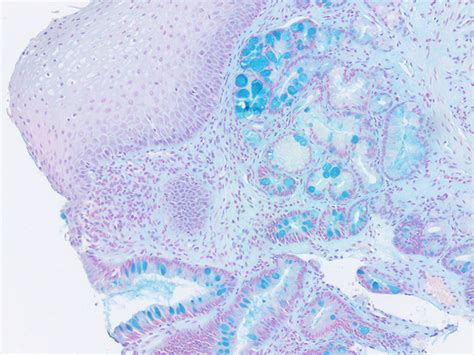 Alcian Blue pH 2.5, Barrett's Esophagus Histology Slides