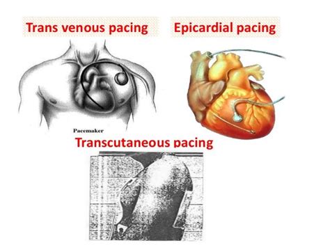 Pin by nonas arc on Epicardial pacing wires | Nurse