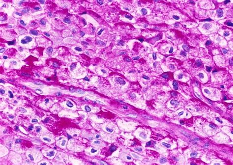 Periodic Acid-Schiff (PAS) Stain: Principle, Procedure, Interpretation and Uses