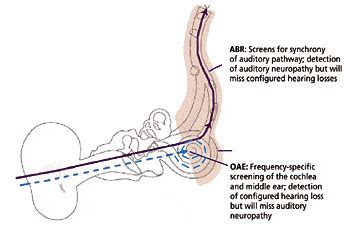 Auditory Neuropathy and Configured Hearing Loss: The Case for Two-Stage ...