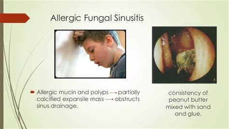 Fungal sinusitis