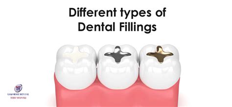 Types Of Tooth Fillings