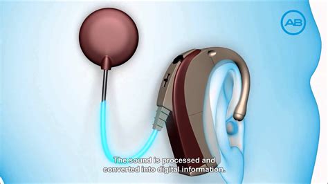 How A Cochlear Implant Works by Advanced Bionics - YouTube